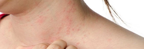 Prevención de las alergias | En Genérico